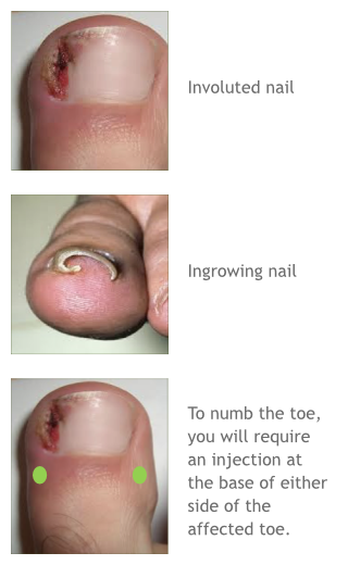 Involuted Toenails - The Foot People